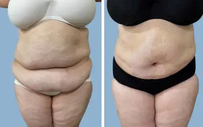 Before and After